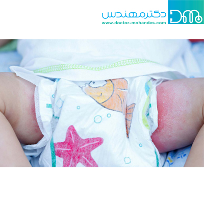 علائم سوختگی پای نوزاد
