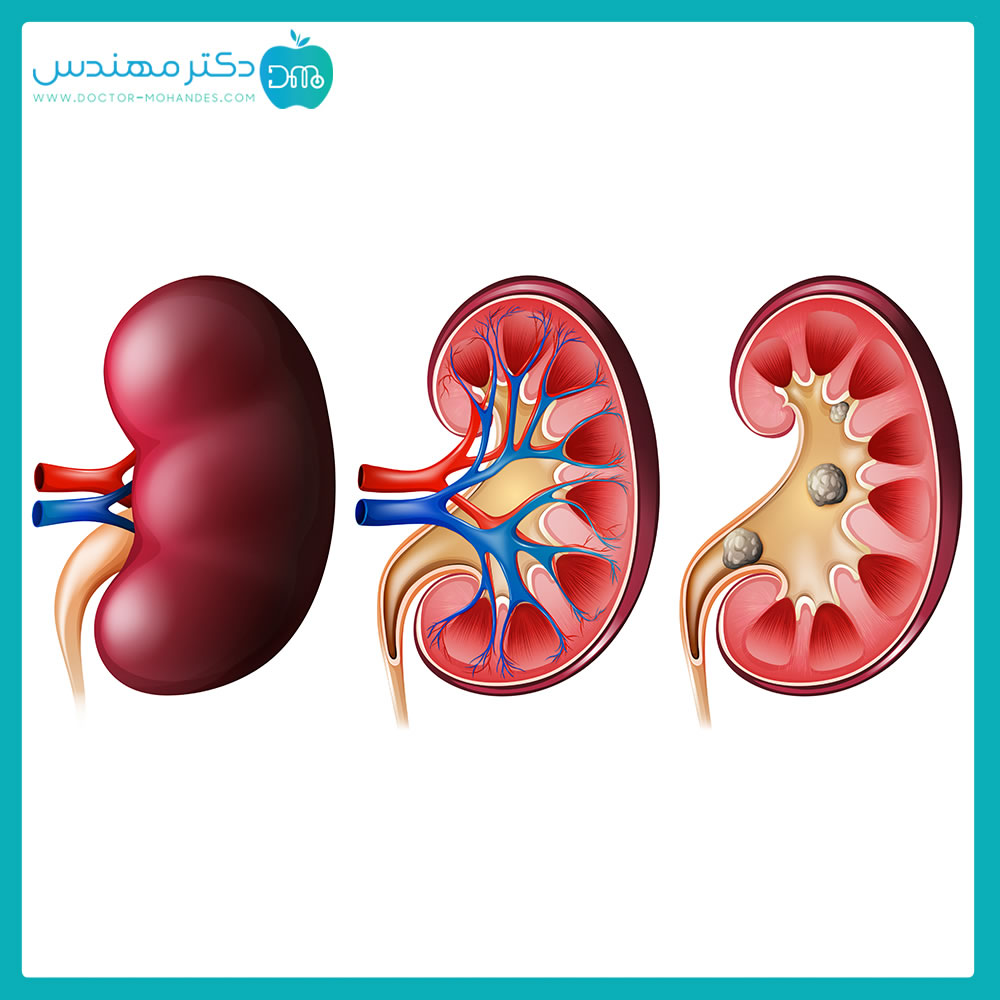 دفع سنگ کلیه بدون نیاز به دارو | درمان فوری و قطعی سنگ کلیه با بادکش کلیه 2 sang01.jpg