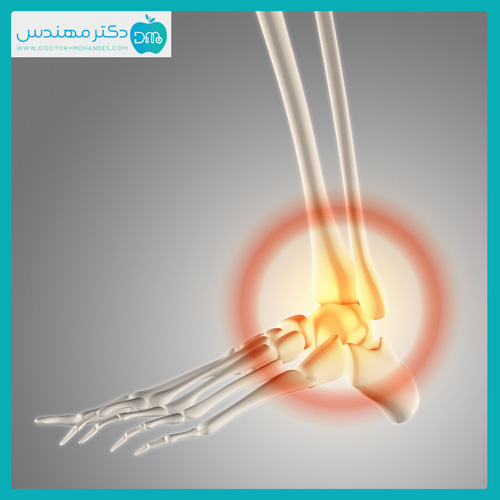 همه چیز در مورد شکستگی مچ پا - طول درمان شکستگی چقدر است؟ 3 ankle-broi.jpg