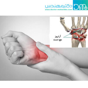 آرتروز یا ساییدگی مچ دست