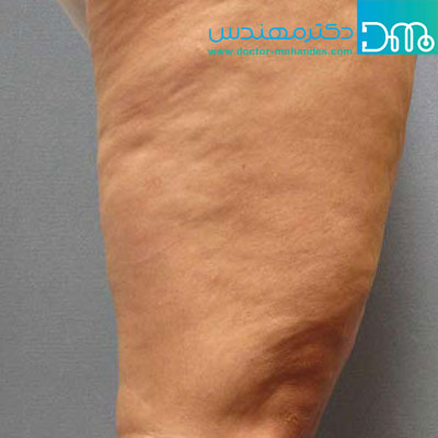 علل ایجاد سلولیت علل ایجاد سلولیت