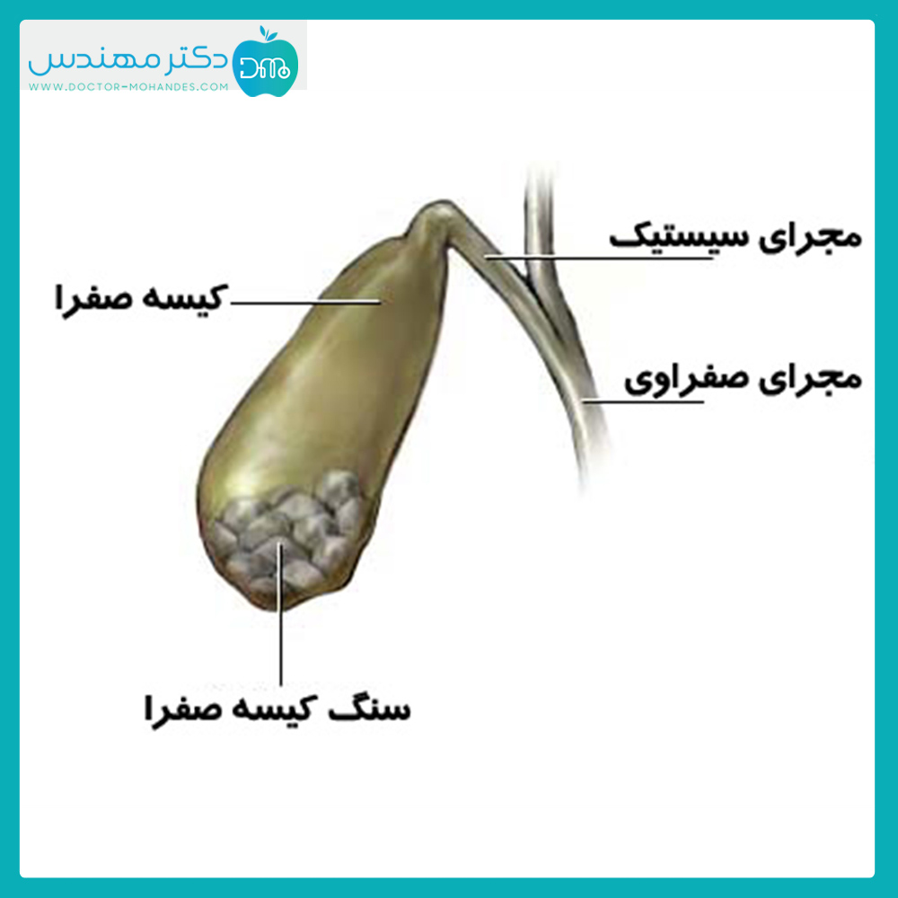 علائم سنگ کیسه صفرا | اندازه طبیعی سنگ کیسه صفرا 2 gallstone.jpg