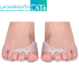 هالوکس والگوس پیشرفته هالوکس والگوس پیشرفته