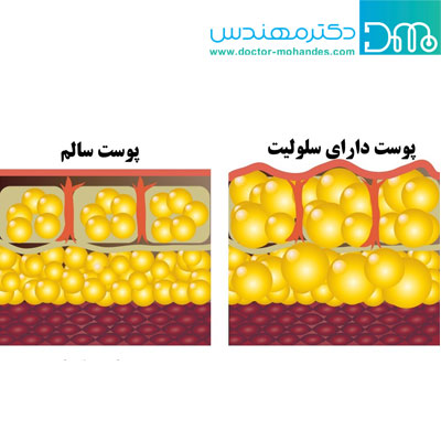 سلولیت چیست؟ سلولیت چیست؟