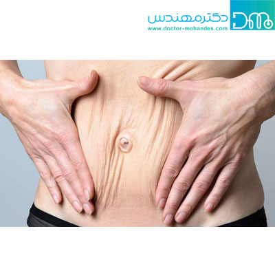 شل شدن پوست بعد از لاغری