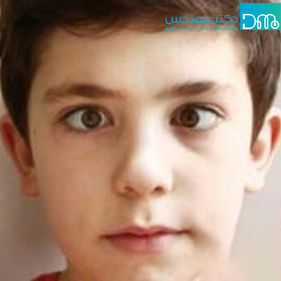 تنبلی چشم چیست tanbali cheshm