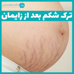 ترک شکم بعد از زایمان