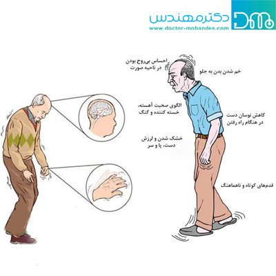 علائم اولیه حرکتی در بیماری پارکینسون علائم اولیه حرکتی در بیماری پارکینسون