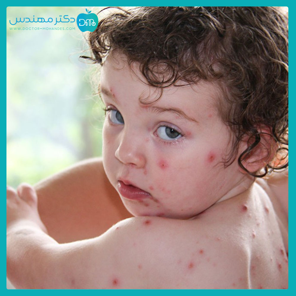 درمان خانگی برای آبله مرغان 6 chicken_pox071.jpg