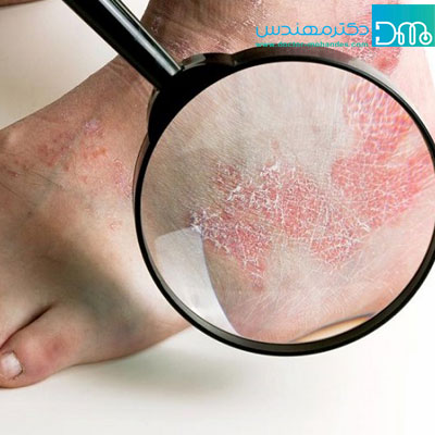 بیماری اگزما چیست و چه علائمی دارد؟
