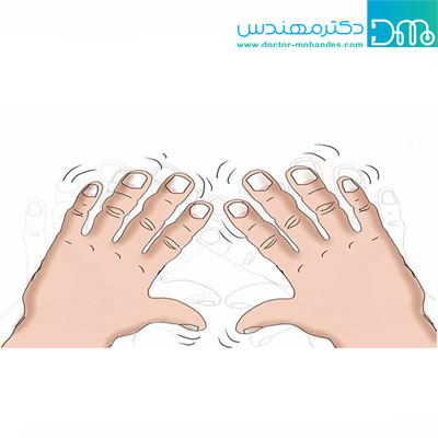 علائم اولیه حرکتی در بیماری پارکینسون علائم اولیه حرکتی در بیماری پارکینسون