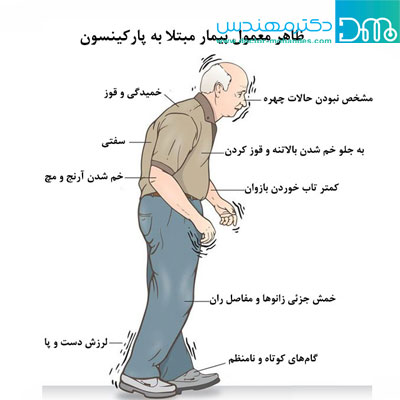 علائم اولیه حرکتی در بیماری پارکینسون علائم اولیه حرکتی در بیماری پارکینسون