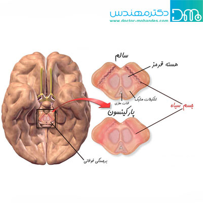 بیماری پارکینسون چیست؟ بیماری پارکینسون چیست؟