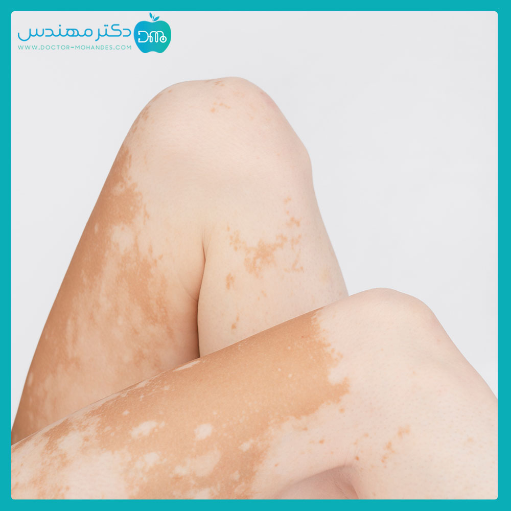 بیماری پیسی واگیردار است؟ 5 pissy-foot09.jpg