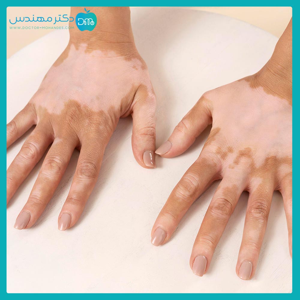 بیماری پیسی واگیردار است؟ 3 pissy-hand09.jpg