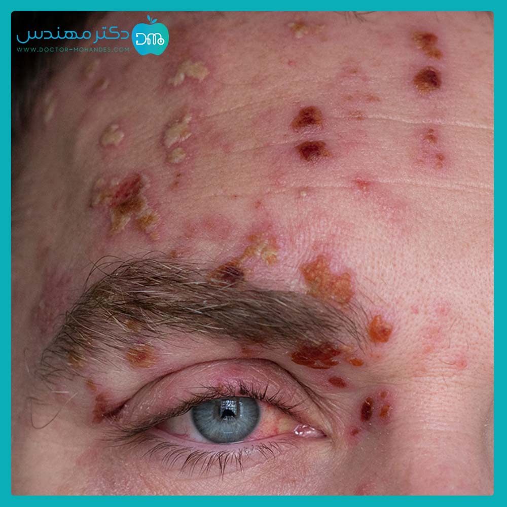 درمان خانگی برای آبله مرغان 3 shingles2.jpg