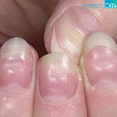نشانههای کمبود ویتامین C alaem kambod vitamin c