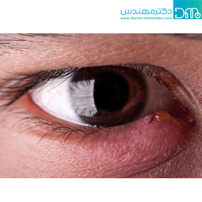 علائم و نشانه‌های گل مژه