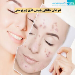 درمان خانگی جوش زیر پوستی