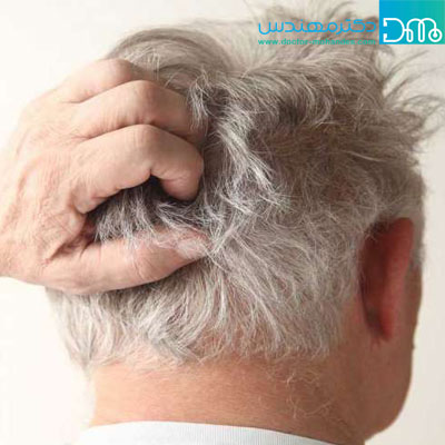 علل خارش کف سر علل خارش کف سر