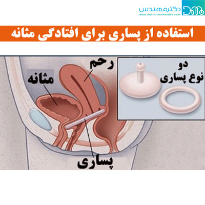 درمان افتادگی مثانه درمان افتادگی مثانه