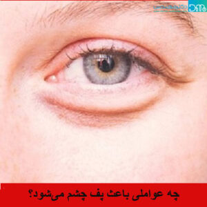 چه عواملی باعث پف چشم می‌شود؟
