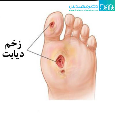 دیابت و بهبود زخم دیابت و بهبود زخم