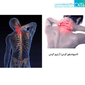 علایم، علل و درمان آرتروز گردن