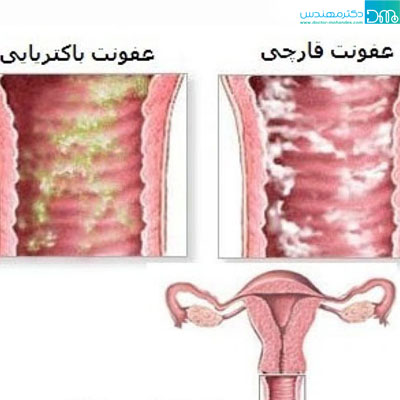 علت خارش واژن elat kharesh vazhen