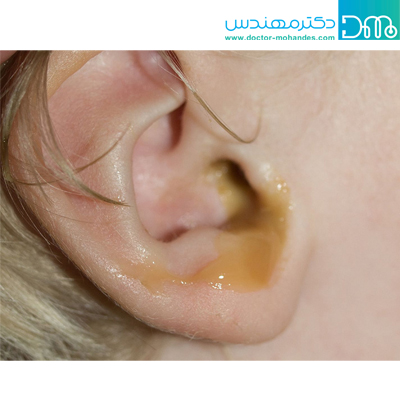 علائم پاره شدن پرده گوش علائم پاره شدن پرده گوش