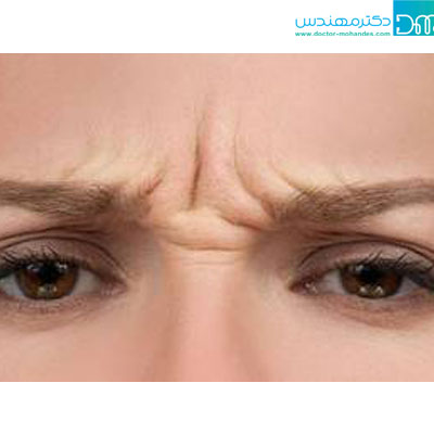 علت ایجاد خط اخم چیست؟ khat akhm