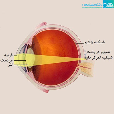 پیر چشمی چیست pircheshmi chist