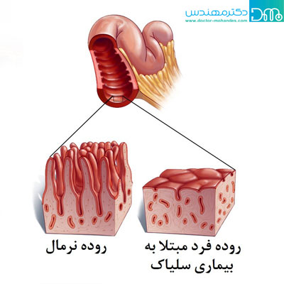 بیماری سلیاک چیست؟ seliac chist