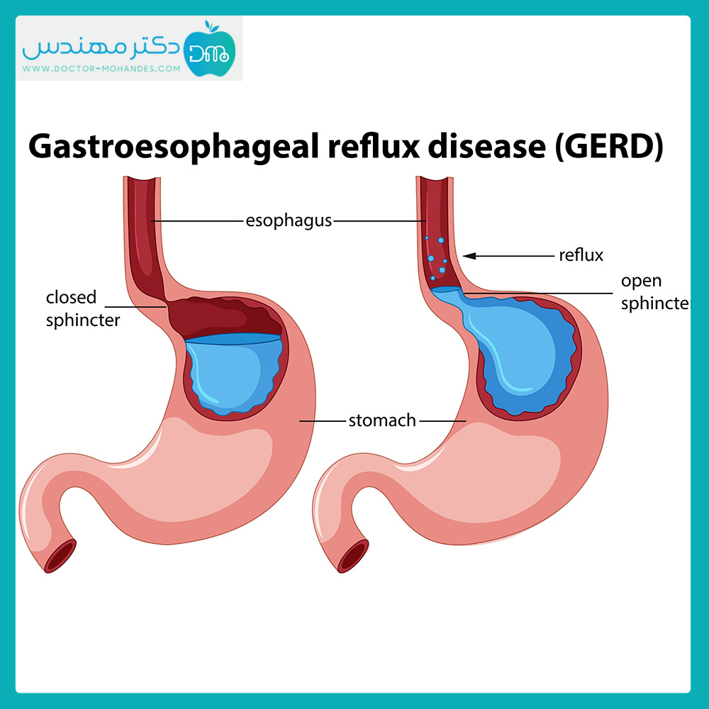 برای کاهش اسید معده چه بخوریم؟ 2 mede02.jpg