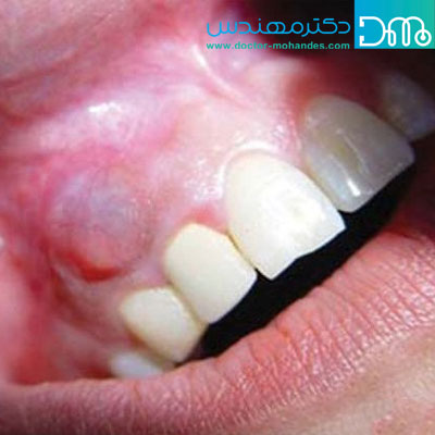 عوارض عفونت دندان عقل kistedandan