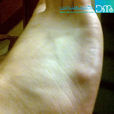چه چیزی باعث ایجاد برآمدگی در قسمت بالایی پا می شود؟ Ganglion cyst