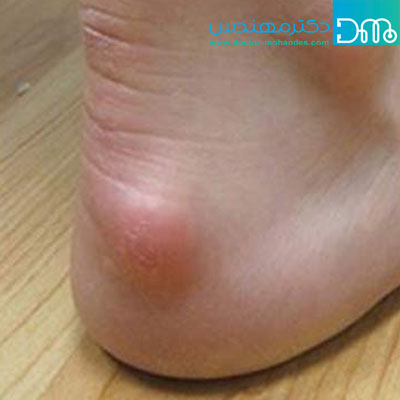 برآمدگی قسمت بالای پا boorisit1