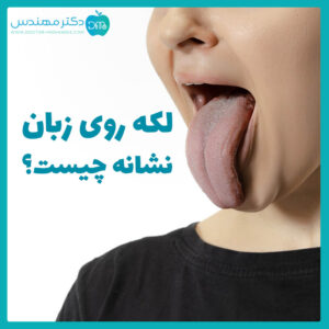 لکه روی زبان