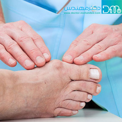 دلایل ایجاد برآمدگی در بالای پا shaste kaj