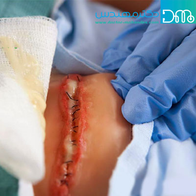 عفونت زخم جراحی ofoonatejarahi