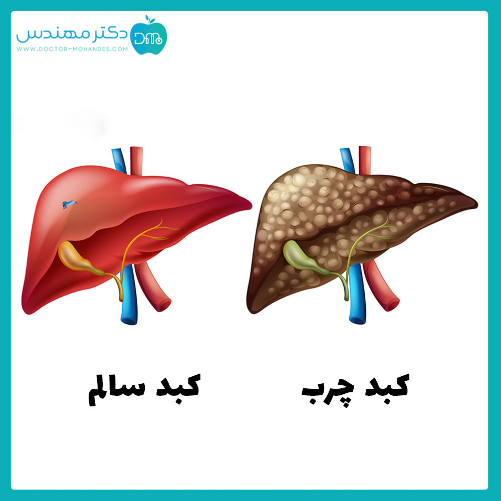 چه غذایی برای کبد چرب خوبه 2 kabed_charb1.jpg
