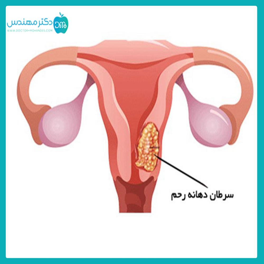 سرطان دهانه رحم چیست؟ 4 rahem02.jpg