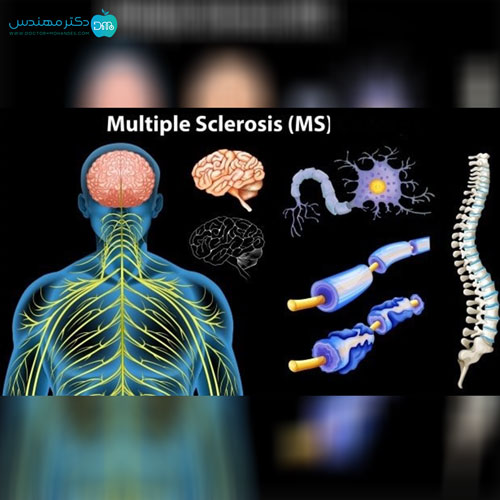 بیماری ام اس (MS)؛ علائم، عوارض، روش تشخیص و درمان قطعی 3 ms7.jpg