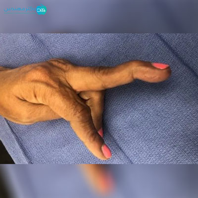 درد انگشتان دست 6 drdangosht6.jpg