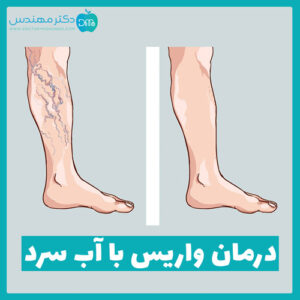 درمان واریس با آب سرد