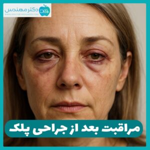 جراحی پلک