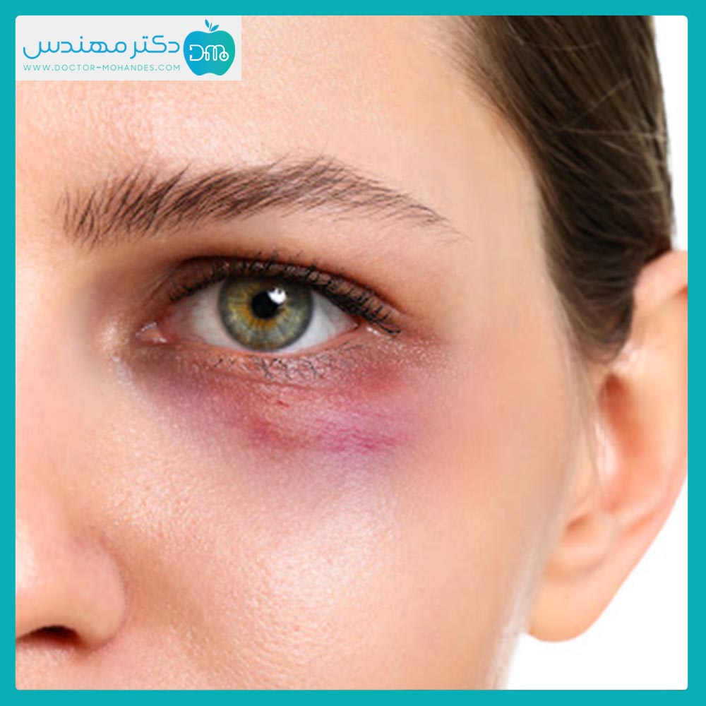 کبودی چشم بعد از عمل بینی